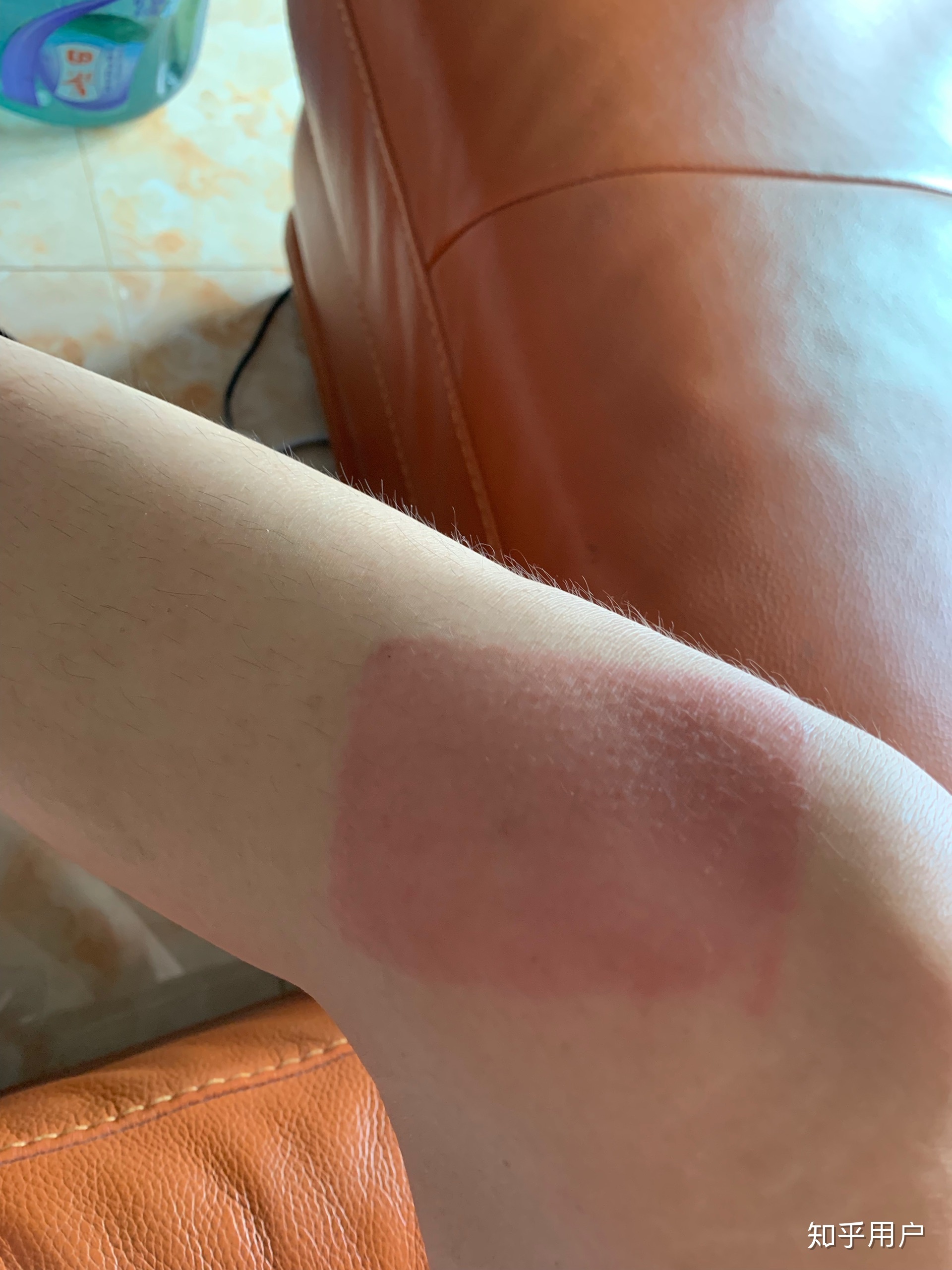 2、貼膏藥的地方有很多紅疙瘩，好不好？